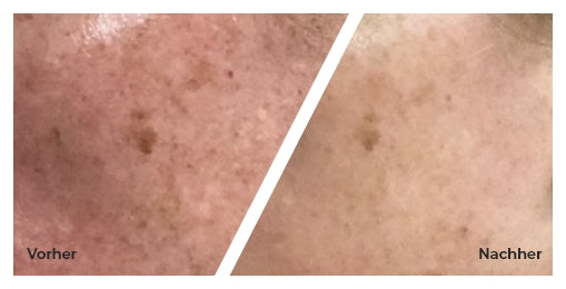 Skincapsule before after