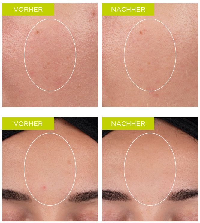 Weitere Vorher-Nachher-Ergebnisse des BIOME+ Dew Bright Serums