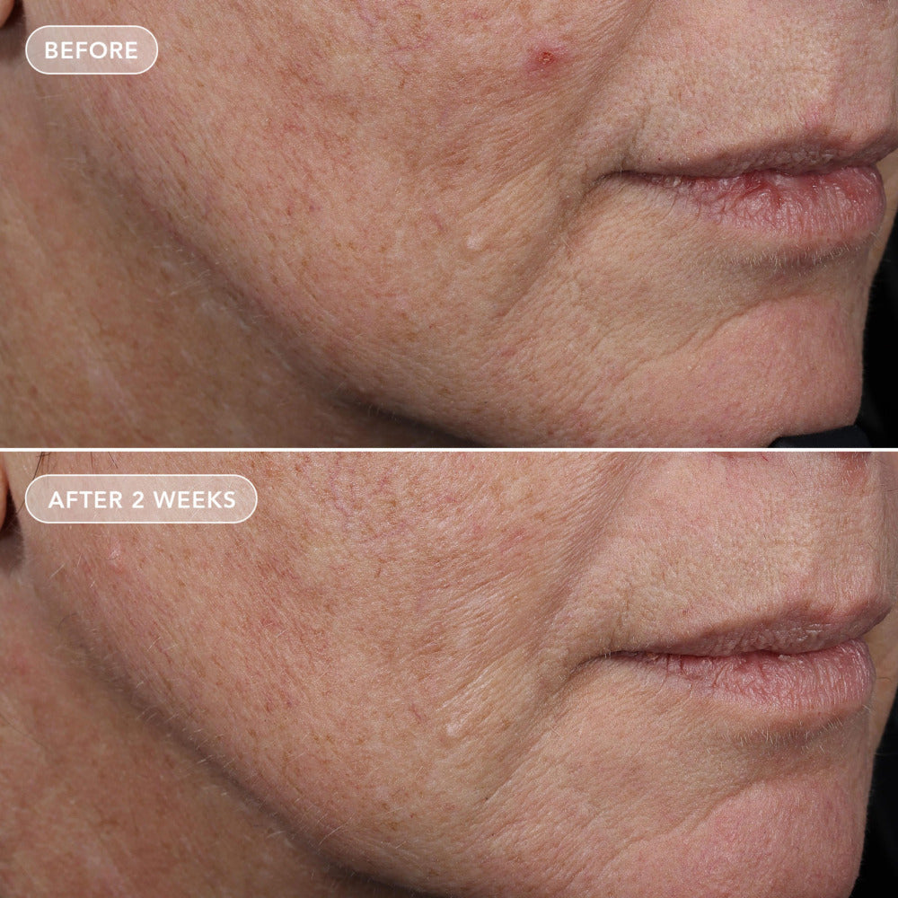 VOL.U.LIFT Study Subject 4